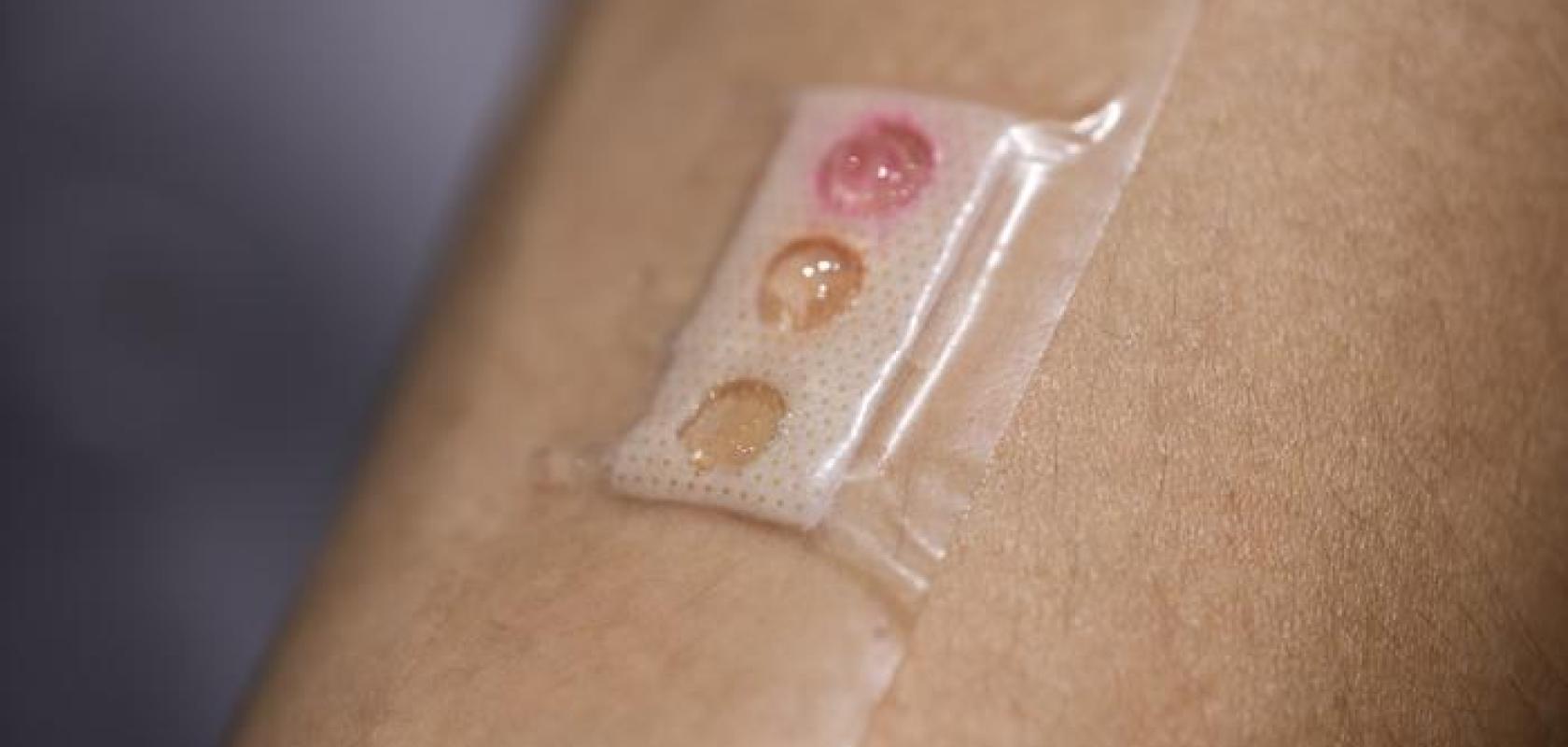 NTU’s ‘smart-plaster’ includes microlaser sensors embedded in liquid crystal droplets, and is customised to read three types of biomarkers, lactate, glucose and urea